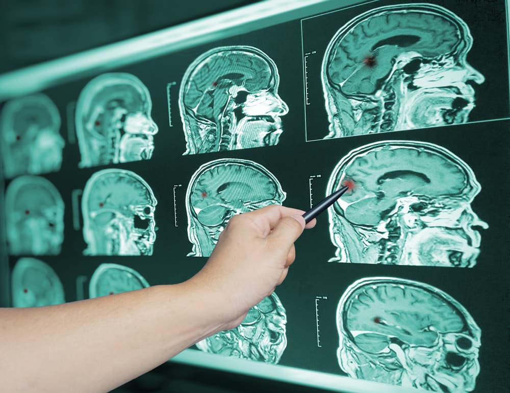 brain injury x-ray