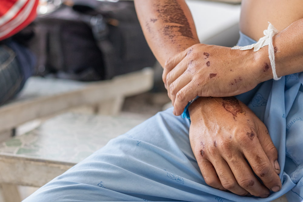 road rash on hands
